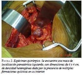 Espécimen Quirúrgico