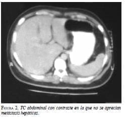 TC Abdominal con contraste en la que no se aprecian Metástosis Hepáticas