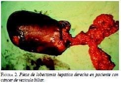 Pieza de Lobectomia Hepática Derecha