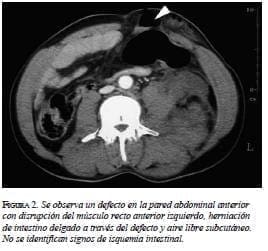 Se observa un defecto abdominal Se observa un defecto abdominal