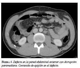 Defecto de la pared abdominal Defecto de la pared abdominal