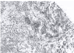 Inmonoperoxidasa positiva para actina focal