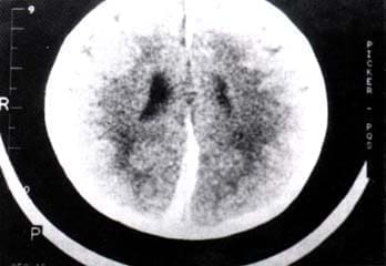 Parasagital frontoparieto-occipital izquierdo