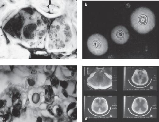 Criptocosis cerebral