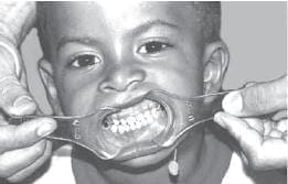 Microsomia plano oclusal