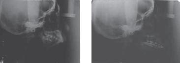 Cefalometria pre y post