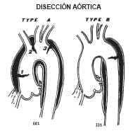 disección Aórtica disección Aórtica