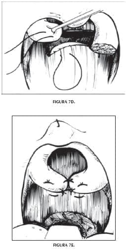 Esfínter muscular dinámico