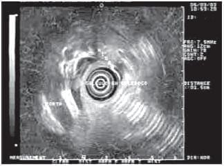 Imagen Hiperecoica en el Centro del Colédoco que Produce Sombra Acústica Posterior