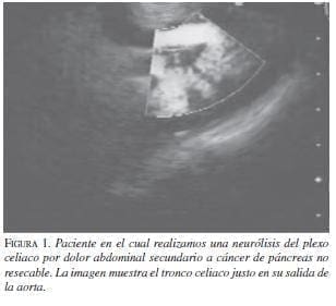 Paciente en e l cual se realiza Neurólisis de Plexo Celiaco