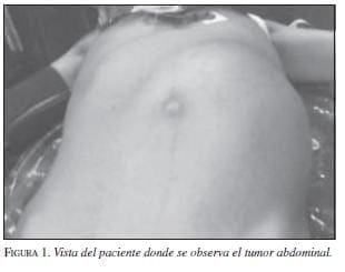 Vista del Paciente donde se Observa el Tumor Abdominal Vista del Paciente donde se Observa el Tumor Abdominal