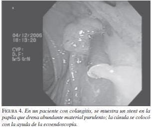 Paciente con Colangitis