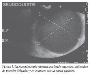 La Ecoendoscopia muestra una Lesión Anecoica