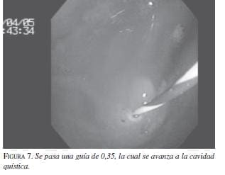 Se pasa una Guía de 0,35, la cual Avanza a la Cavidad Quística