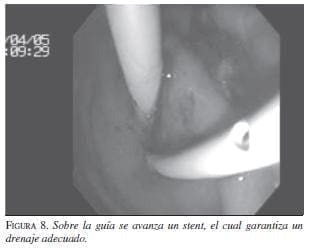 Sobre la Guía se Colocan uno o dos Stents de doble Cola