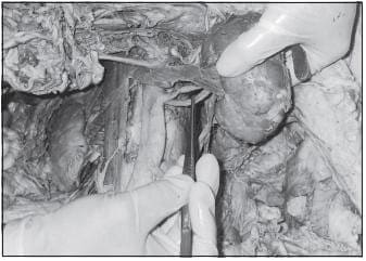 Arteria Renal Doble: Las arterias son de gran volumen Arteria Renal Doble: Las arterias son de gran volumen