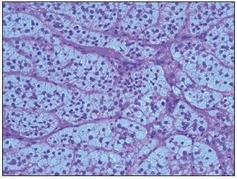 Componente Adenomatoso del Tumor
