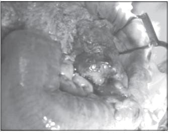 Tumor De Burkitt que Compromete el Ángulo Esplénico del Colon