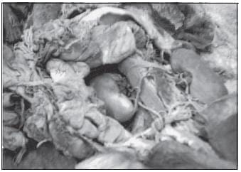 Arteria Renal Polar Inferior Arteria Renal Polar Inferior