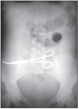 Cuerpo Extraño Olvidado en la Cavidad Abdominal (pinza de Kelly). Cuerpo Extraño Olvidado en la Cavidad Abdominal (pinza de Kelly).