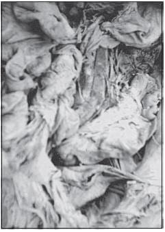Arteria Rectal Superior De La Sigmoidea Arteria Rectal Superior De La Sigmoidea
