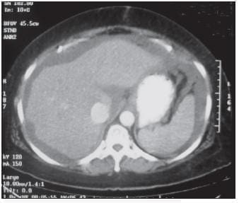 TC Abdominal que Demuestra Abundante Ascitis y Engrosamiento Peritoneal