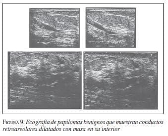 Ecografias de Papilomas Benignos