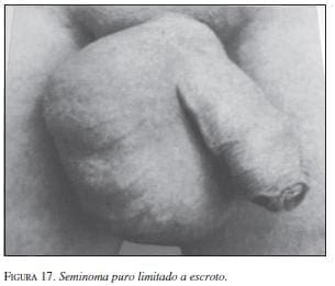 Seminoma puro Limitado a Escroto