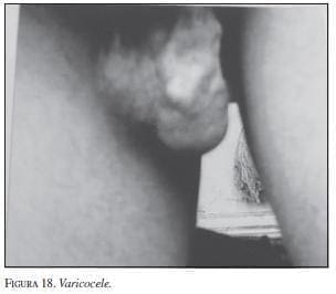 varicocele