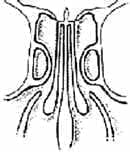 Techo Ethmoidal Tipo I