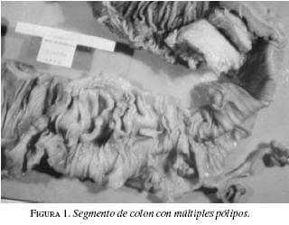 Segmento de Colon con Múltiples Pólipos