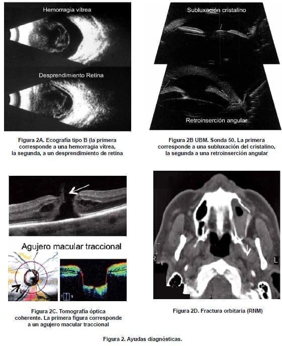 Trauma Ocular, Ayudas diagnósticas