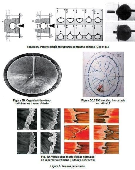 Trauma Ocular penetrante 