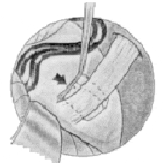 Asa vascular el implante