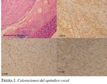 Coloraciones del Apéndice Cecal