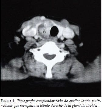 Tomografía Computadorizada de Cuello
