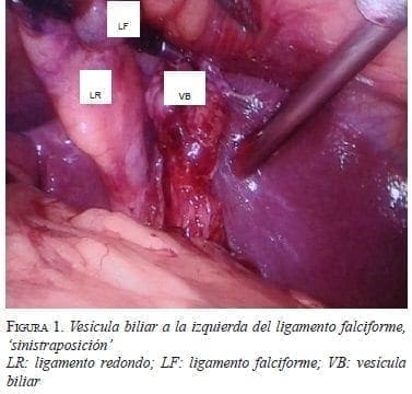 Vesícula biliar a la izquierda del Ligamento Falciforme Vesícula biliar a la izquierda del Ligamento Falciforme