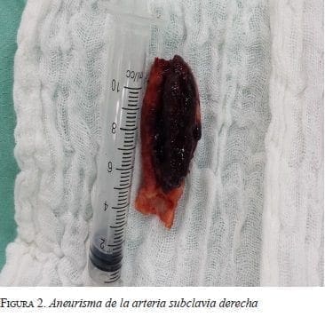 Aneurisma de la Arteria Subclavia Derecha Aneurisma de la Arteria Subclavia Derecha