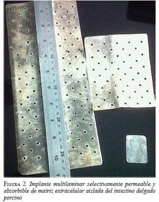 Implante Multilaminar Selectivamente Permeable y Absorbible de Matriz 