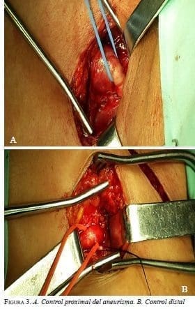 Control proximal del Aneurisma y Control Distal Control proximal del Aneurisma y Control Distal