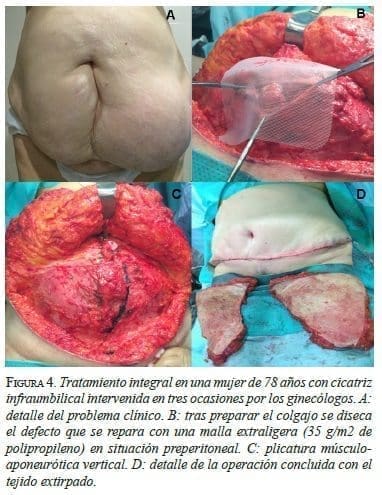 Tratamiento Integral en una Mujer de 78 Años con Cicatriz Infraumbilical