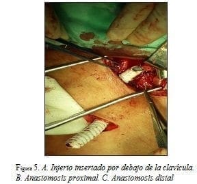 Injerto Insertado por debajo de la Clavícula Injerto Insertado por debajo de la Clavícula