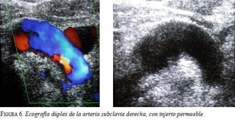 Ecografía Dúplex de la Arteria Subclavia Derecha, con Injerto Permeable Ecografía Dúplex de la Arteria Subclavia Derecha, con Injerto Permeable