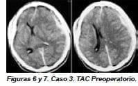 Caso 3. TAC Preoperatorio