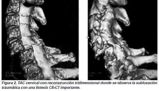 Subluxación Traumática con una Listesis