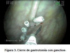 Cierre Gastrotomía con Ganchos