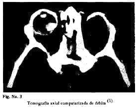 Tomografia axial Tomografia axial