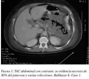 TAC abdominal con contraste