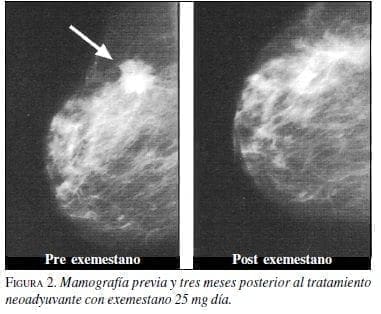 Mamografía Previa y tres meses posterior al Tratamiento Neoadyuvante