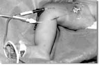 Catéter Venoso Central, Femoral Derecho, Bilumen.